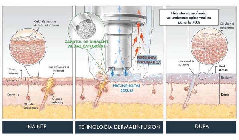 Tratamentul DERMALINFUSION