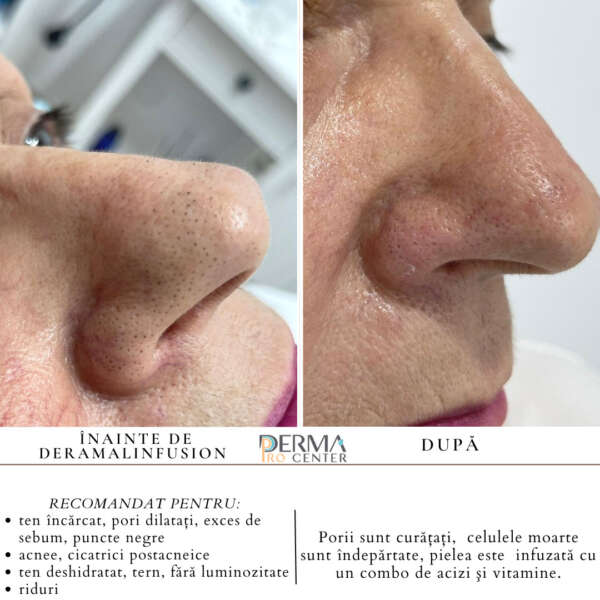 Dermalinfusion Before After