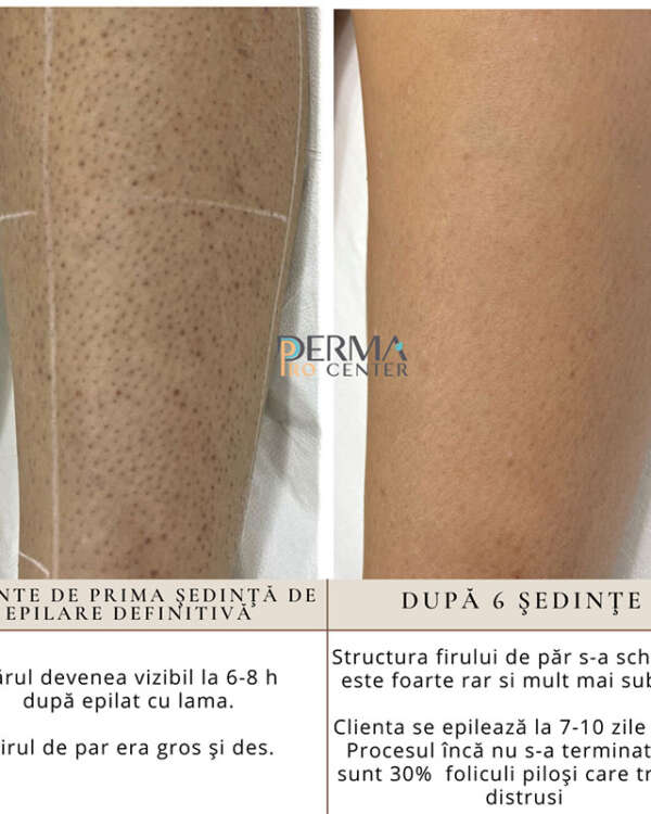 Epilare definitivă - Before After Epilare definitivă - Before After