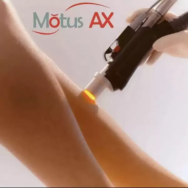 Epilare laser DEKA Epilare laser DEKA