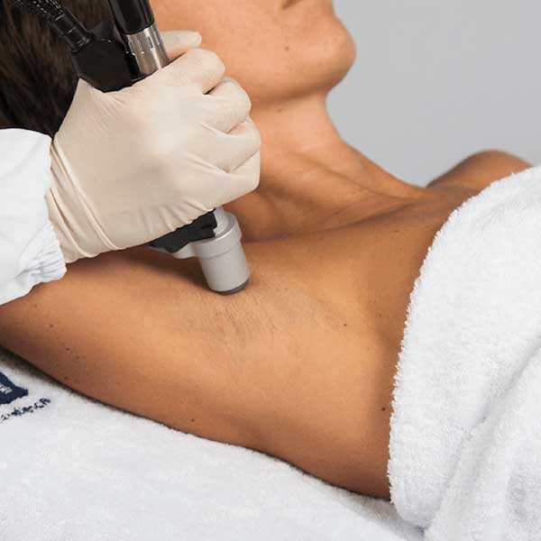 Epilare laser DEKA Epilare laser DEKA