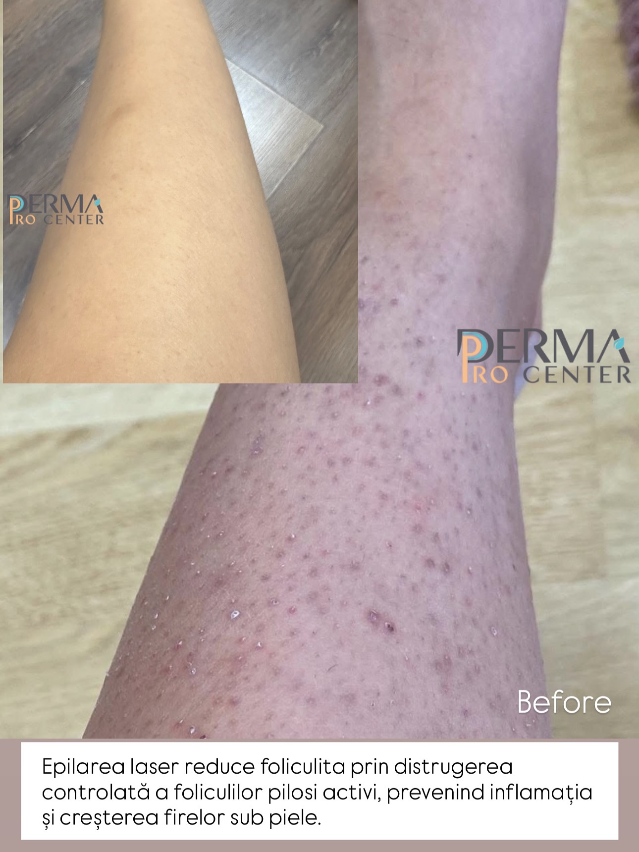 epilare laser deka alexandrite