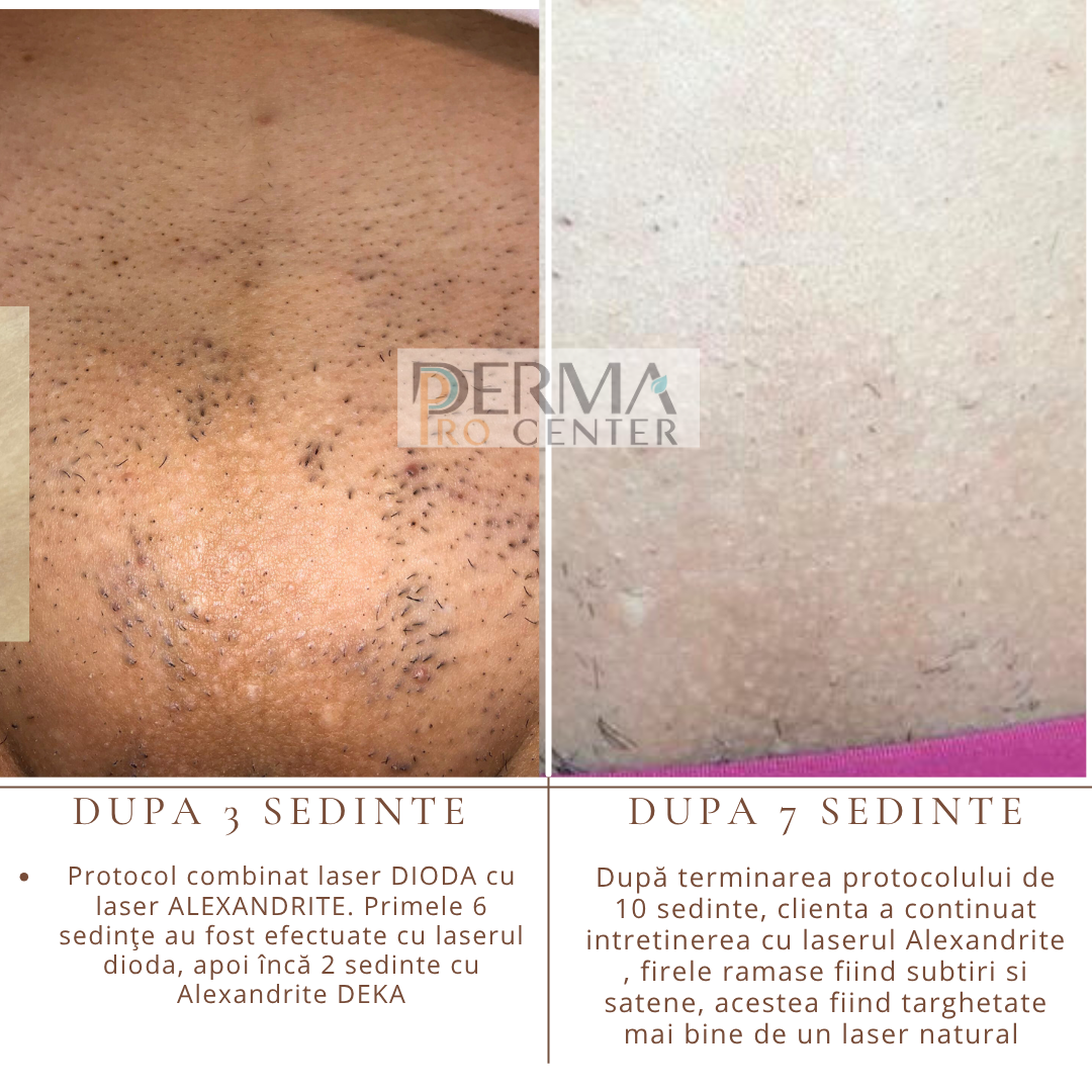 epilare laser dioda