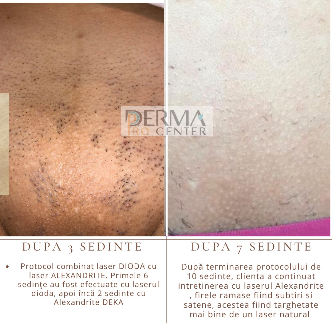 rezultate epilare laser
