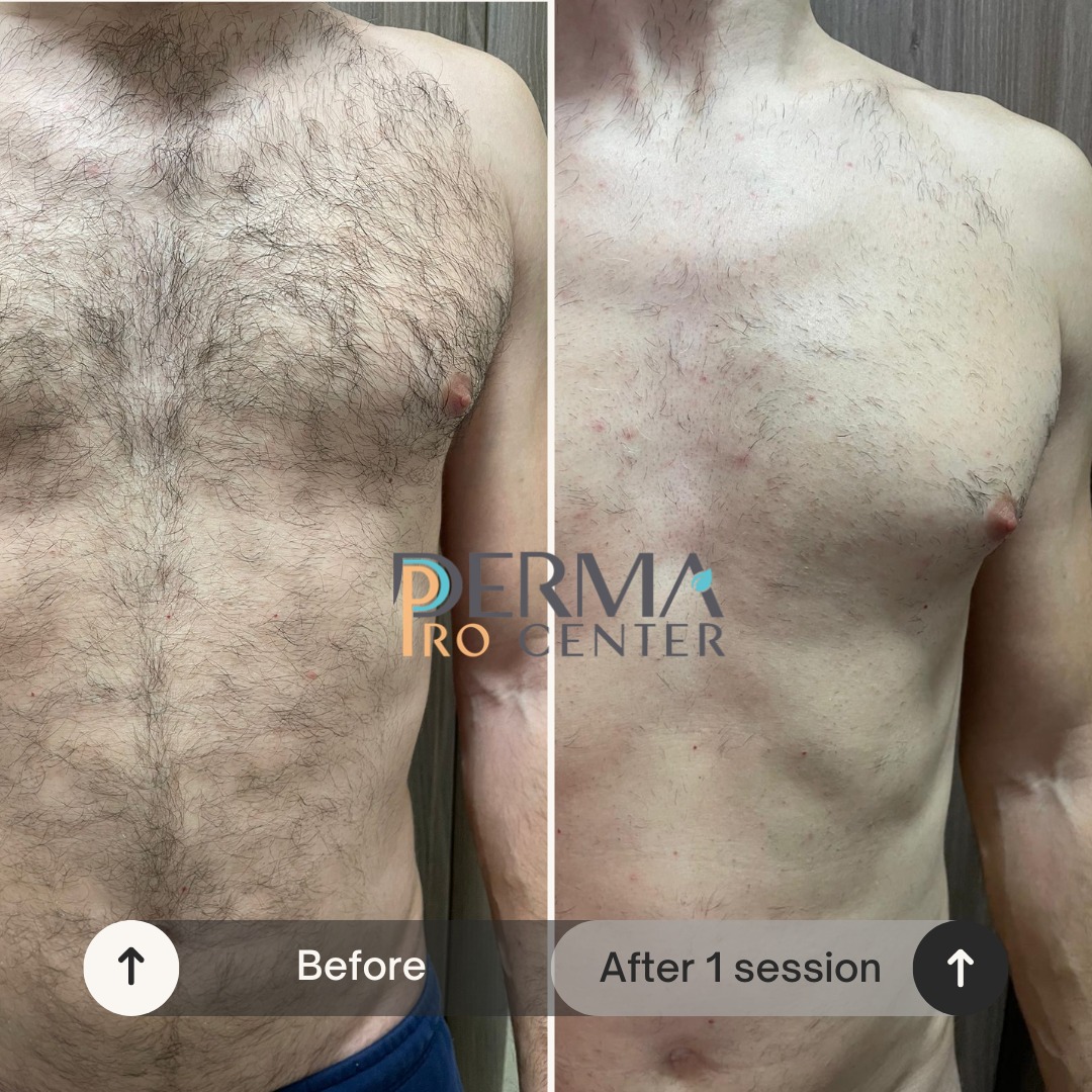 rezultate epilare laser
