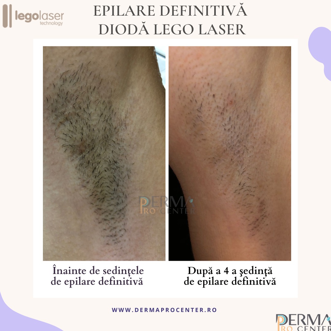 rezultate epilare laser