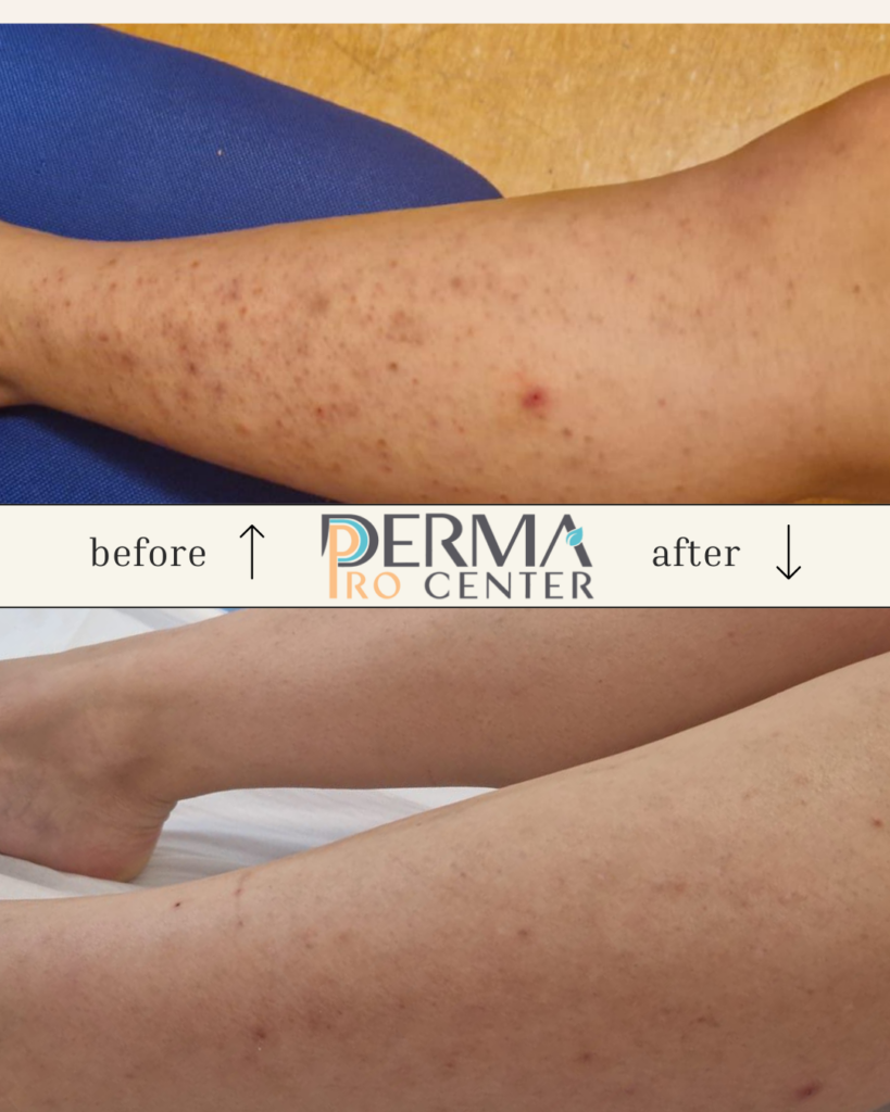 rezultate epilare laser