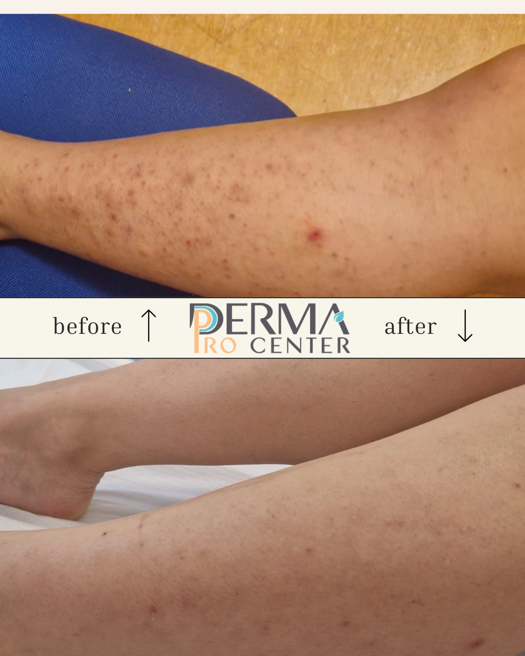 rezultate epilare laser