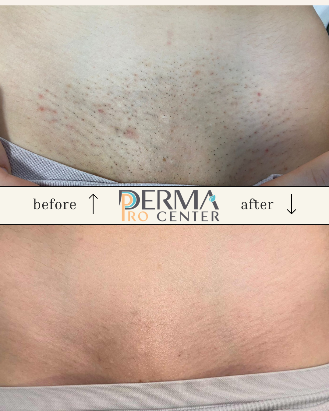 rezultate epilare laser