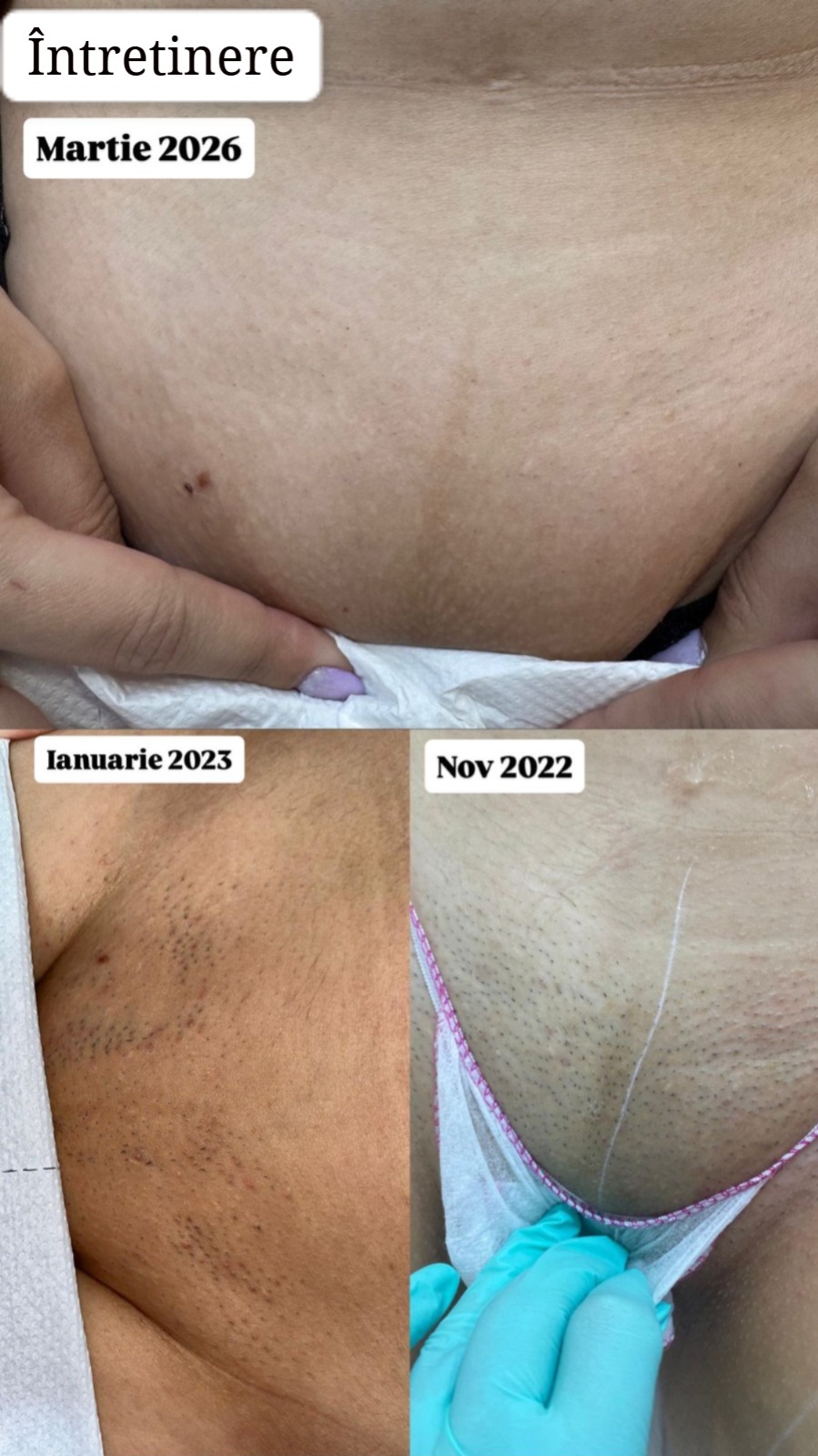 rezultat epilare laser