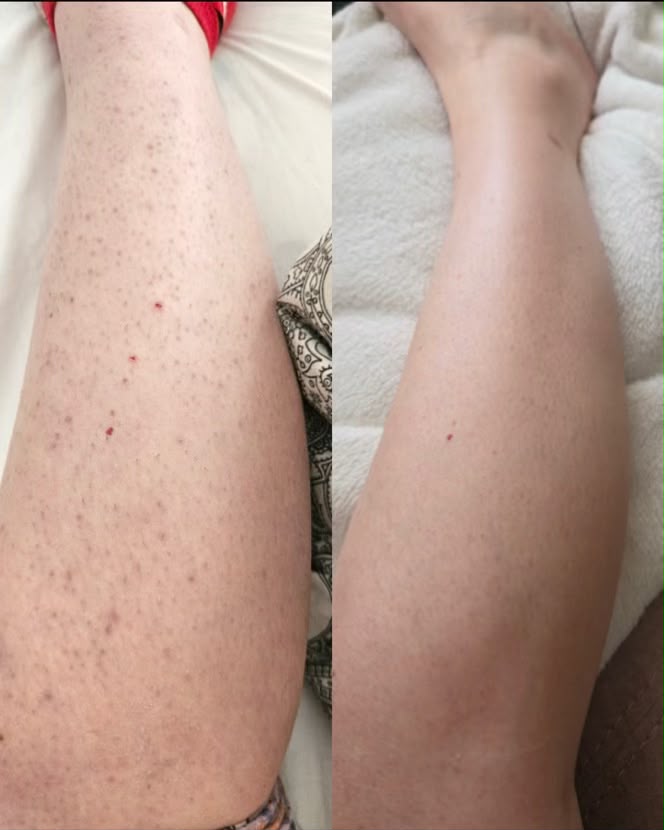 epilare laser dioda